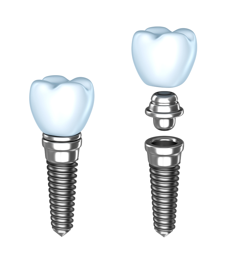 Dental Implants in Houston, TX
